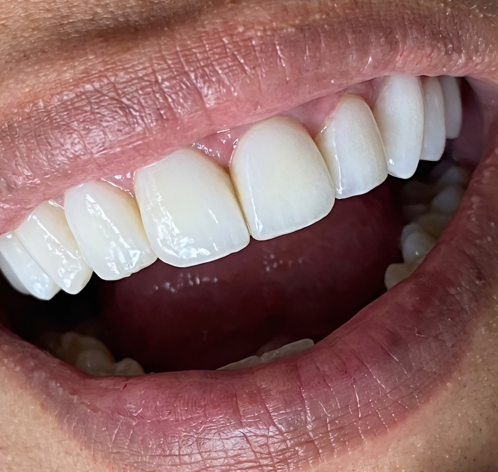 Antes e depois de tratamento de estética dental em resina