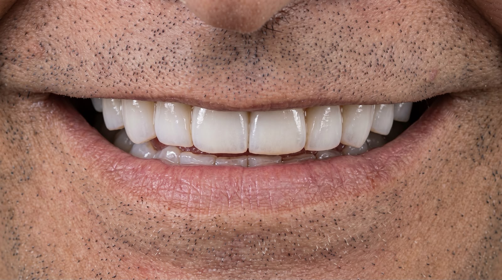 Resultado de transformação do sorriso com facetas